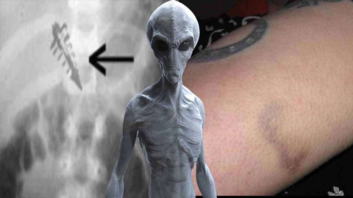 implantes alienígenas