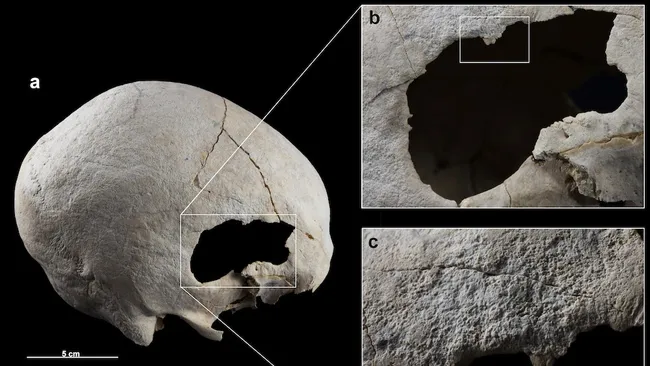 Crânio de 4.500 anos revela duas cirurgias