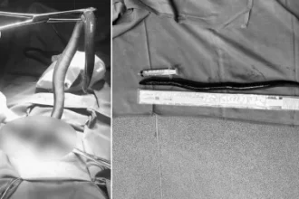 Médicos removem enguia viva do abdômen de um homem