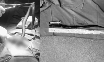 Médicos removem enguia viva do abdômen de um homem