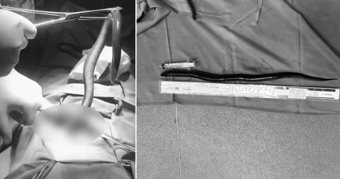 Médicos removem enguia viva do abdômen de um homem